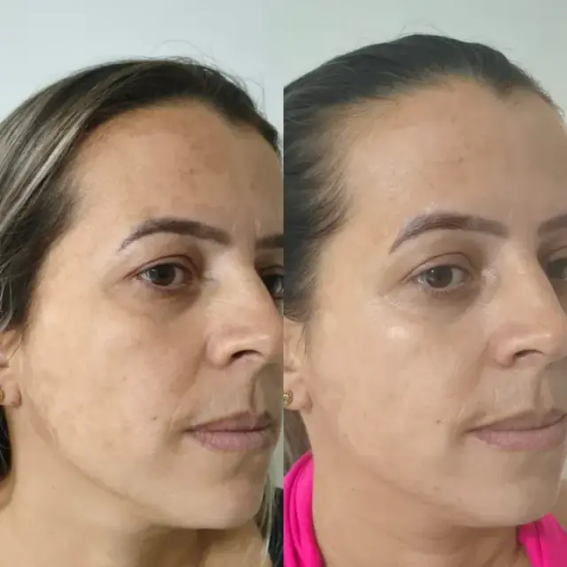 Foto de antes e depois de uma cliente, 4 de 24
