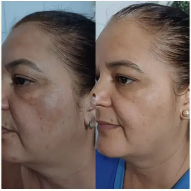 Foto de antes e depois de uma cliente, 9 de 24