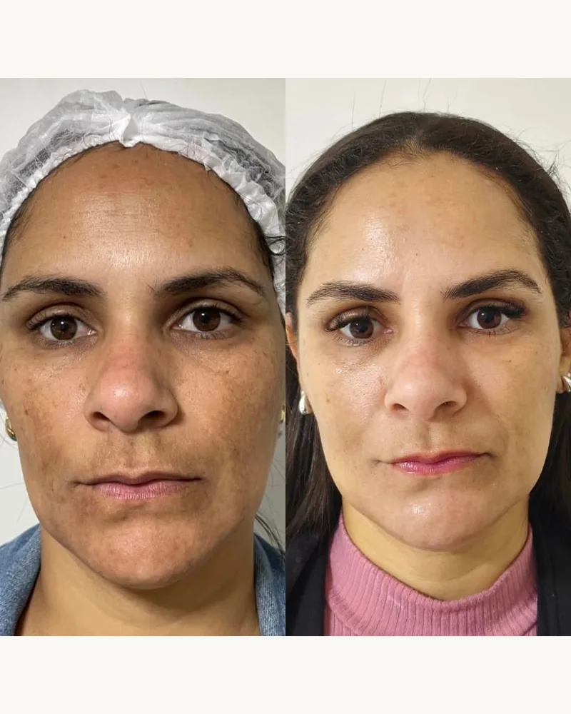 Protocolo Peeling Clareador DermAna: sérum, sabonete, creme clareador e creme hidratante, foto 2 de 4