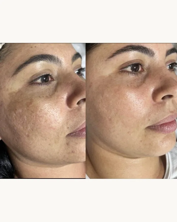 Protocolo Peeling Clareador DermAna: sérum, sabonete, creme clareador e creme hidratante, foto 3 de 4