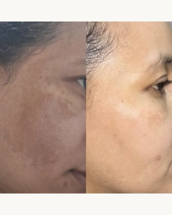 Protocolo Peeling Clareador DermAna: sérum, sabonete, creme clareador e creme hidratante, foto 4 de 4