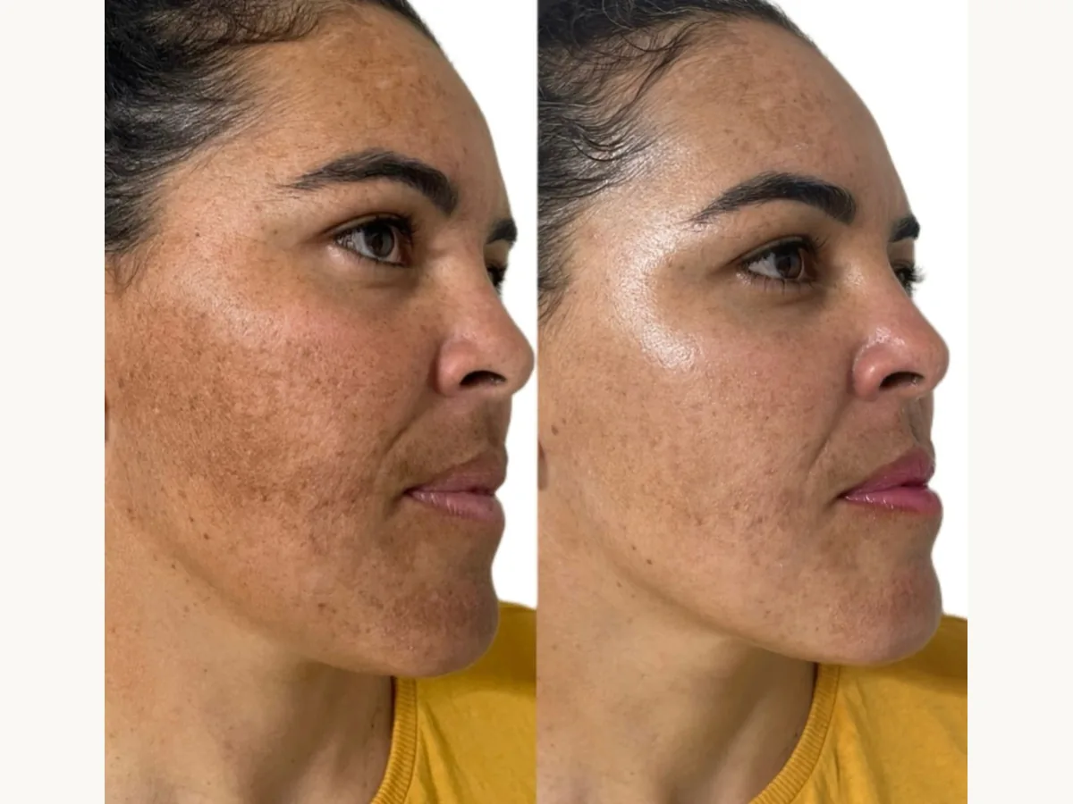 Antes e depois de uma cliente, de perfil
